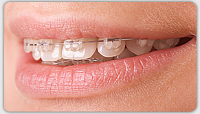 Types of Braces « Art of Orthodontics